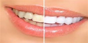white teeth upcharnuskhe