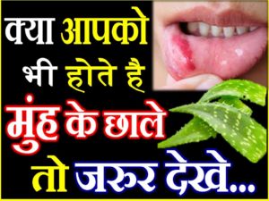 मुंह के छाले दूर करने के लिए अपनाएं ये 5 घरेलू उपाय Best Home Remedies for Mouth Ulcers