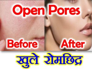 Open Pores Home Remedies