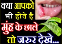 मुंह के छाले दूर करने के लिए अपनाएं ये 5 घरेलू उपाय Best Home Remedies for Mouth Ulcers