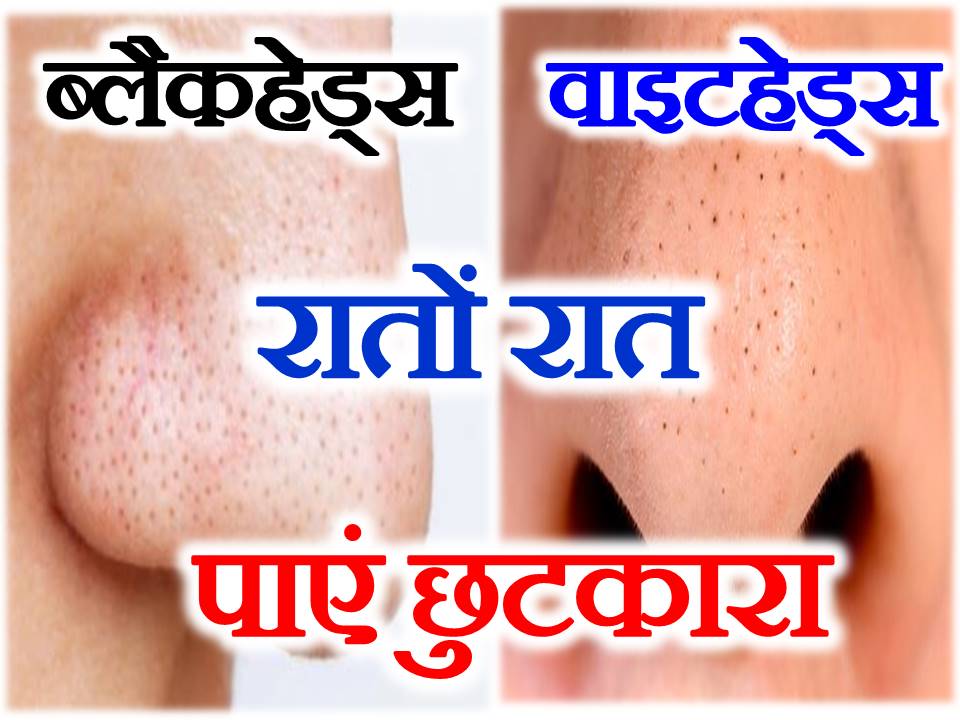 Blackheads Whiteheads Remove At Home ब्लैकहेड्स वाइटहेड्स उपाय